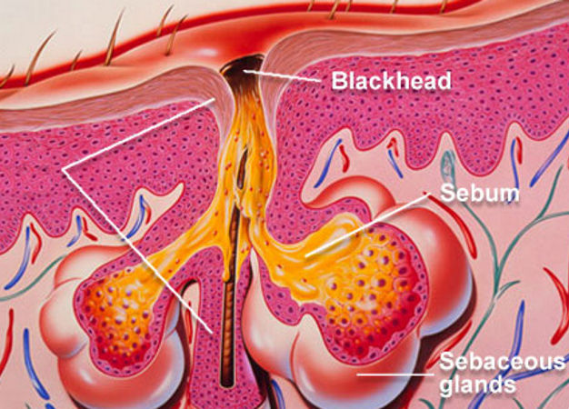 dermo acne treatment
