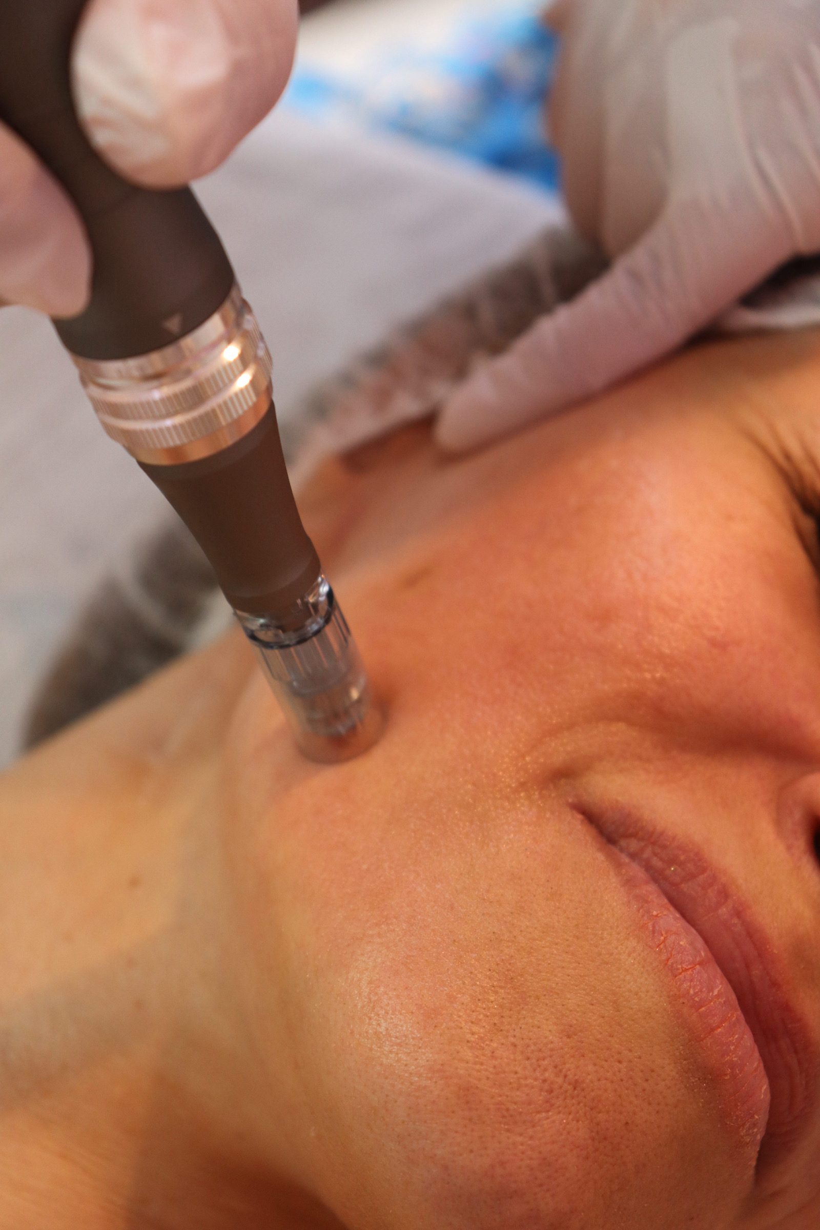 Μεσοθεραπεία προσώπου